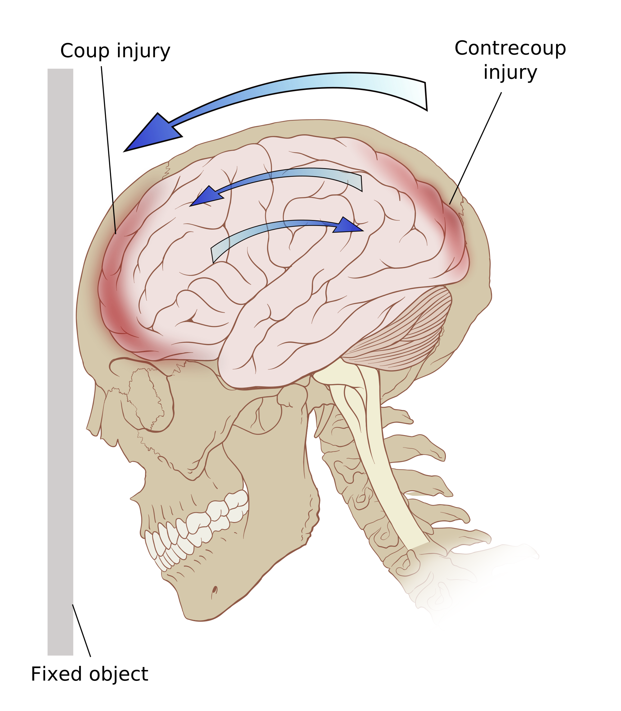 Brain Injury-Law
